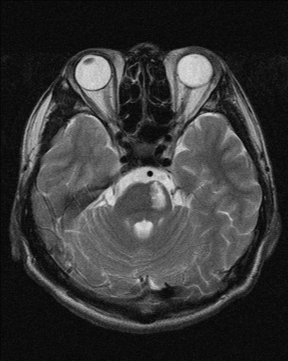MRI脳画像